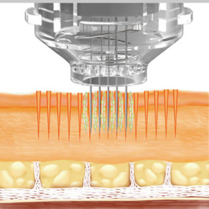 کاربرد سوزن میکرونیدلینگ برای جوانسازی 